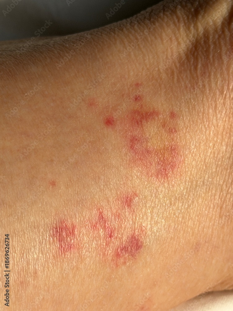 Fototapeta premium Vasculitis blood vessel inflammation on the lower leg above the ankle