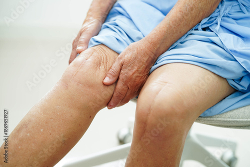 Photos Asian elderly woman patient with scar knee replacement surgery in hospital