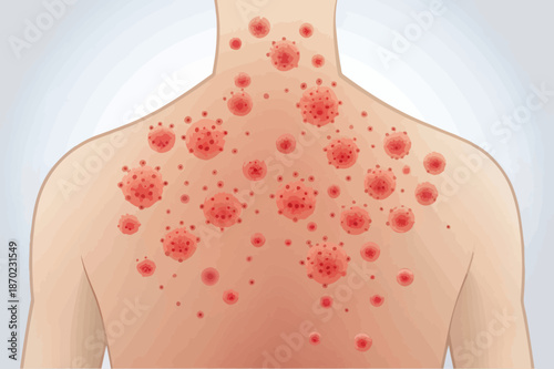 Illustration of Shingles Rash on Human Skin
