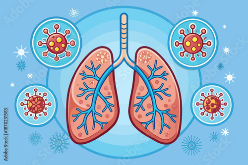 Illustration of Lungs Infected by Viruses