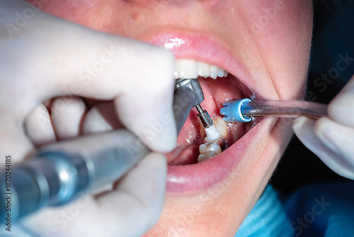 Valokuva Dentist applying bonding agent to prepared tooth before dental crown cementation
