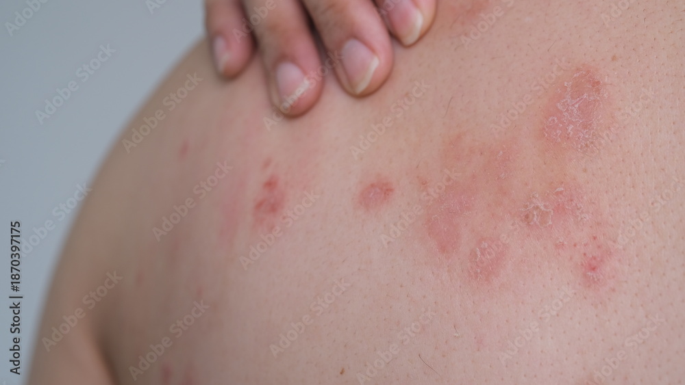Fototapeta premium A man with his Psoriasis on his back.