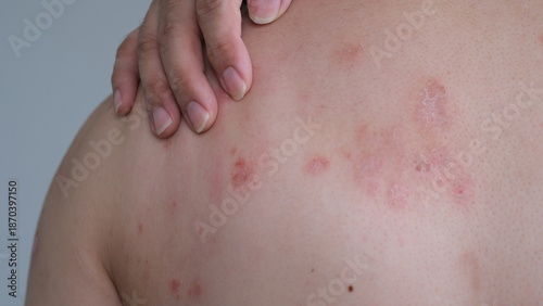 Canvastavla A man with his Psoriasis on his back.