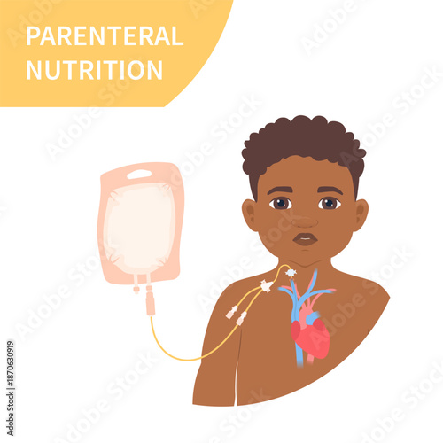 Young patient receiving parenteral nutrition through a central intravenous IV access. Clinical feeding therapy in critical care for malnourished pediatric patients in hospitals. Vector illustration.