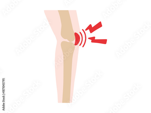Hand Drawn Bursitis Prepatellar Disease in Knee
