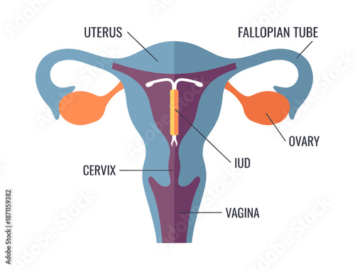 IUD in female reproductive system flat illustration