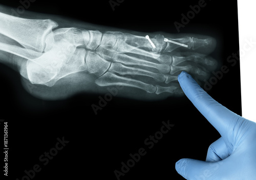 Finger in blue medicine glove point at X-ray of the front foot after Hallux Valgus surgery sideview white background