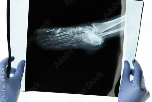 Two hands hold the film front of X-ray of the front foot after Hallux Valgus surgery white background