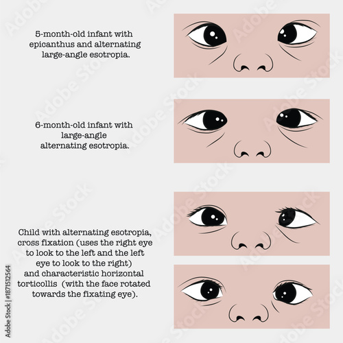 Amblyopia and strabismus: decreased visual acuity in one or both eyes.