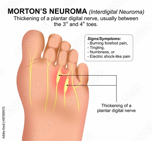 Morton’s Neuroma Foot Medical Flashcard