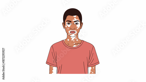 Portrait of a Young Man with Vitiligo Skin Condition.