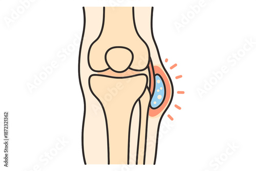 Diagram showing a knee joint with a bursa and inflammation in a human body for educational purposes