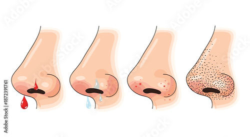 Medical diagram showing various nose conditions including nosebleed, runny nose, acne, and blackheads on a skin profile.
