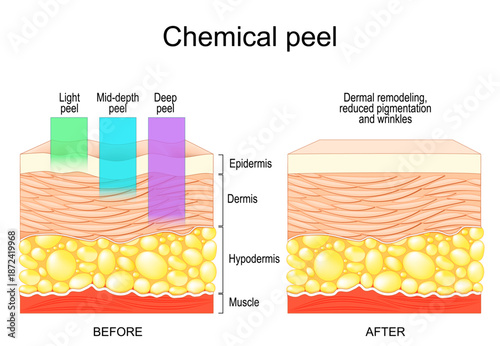 Chemical peeling. Human skin Before and after exfoliation. Dermatological procedure. Wrinkle reduction. 