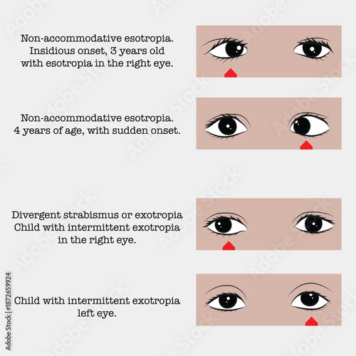 Accommodative esotropia and persistent strabismus: eye diseases in children.