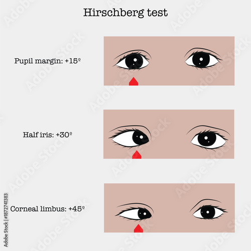 Hirschberg test: position of corneal light reflexes, measurement of visual deviation.