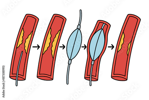 Understanding the process of blood vessel narrowing and the use of medical devices to treat it