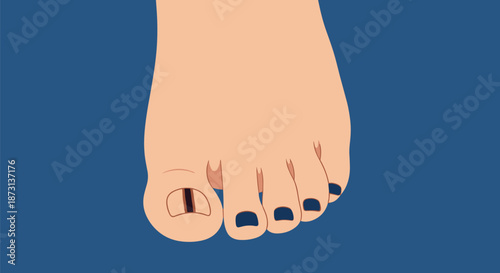 Close up view of a human foot with dark blue or black nail polish on four toes and a damaged black big toenail.