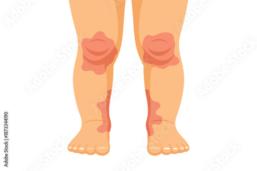 An illustration of a person's legs with red skin patches on knees