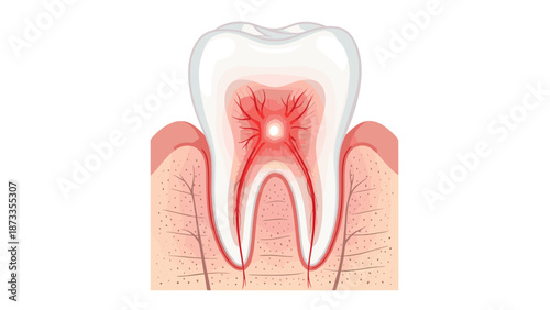 A medical illustration of a human tooth showing an inflamed pulp chamber with red radiating pain lines, indicating a severe toothache or infection requiring dental care.