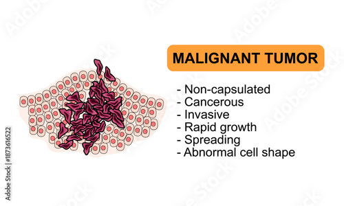 Vector Illustration of a malignant tumor. Characteristics of malignant tumors, cancer cells, invasive. Illustration for medical diagrma, design element, poster, or education.