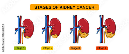 Illustration of the stage of kidney cancer. The development of cancer in human kidney, problems in the urinary system. Vector illustration for education, medical, clinic and science.