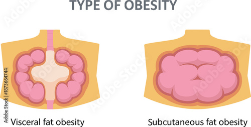 Comparison of visceral fat obesity vs subcutaneous fat obesity anatomical diagram showing internal organ fat and adipose tissue under skin layers
