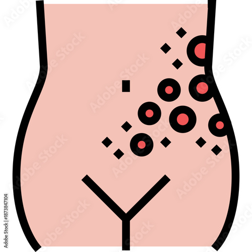 Illustration of skin rash on torso