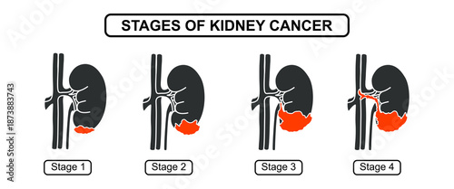 Illustration of the stage of kidney cancer. The development of cancer in human kidney, problems in the urinary system. Vector flat symbol illustration for education, medical, clinic and science.