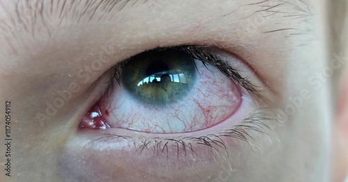 Closeup irritated infected red bloodshot eyes, conjunctivitis concept