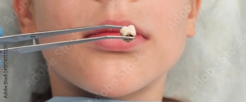 Tableau sur toile Dental extraction in a clinic during a routine appointment, showing removed toot