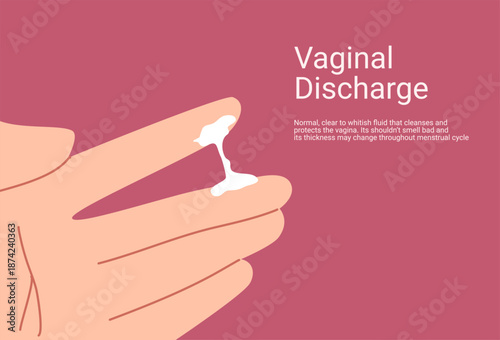 Vaginal discharge symptoms, medical concept of yeast infection, bacterial vaginosis and female reproductive health. Abnormal discharge vector illustration