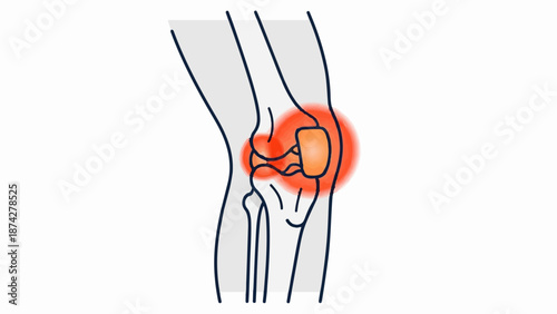 Stylized illustration of a knee joint with radiating red heat indicating pain or inflammation