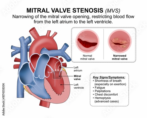 Fotografia Mitral Valve Stenosis (MVS) Medical Flashcard