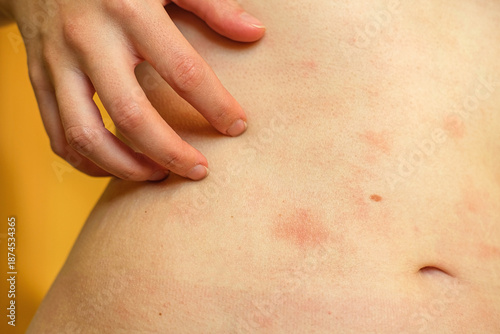 Tableau sur toile Atopic dermatitis on the abdominal skin of a woman, severe itching on the side
