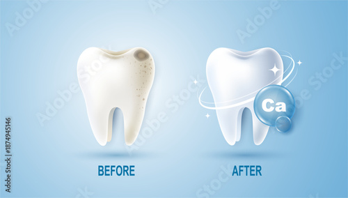 Set of dental cleaning and calcium for teeth concept. comparison of clean and dirty tooth. dental health and oral hygiene poster for dentistry. examination teeth, whitening and repair. vector design.