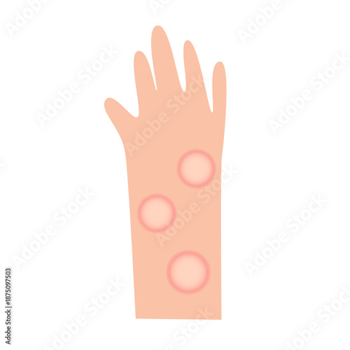 leprosy disease concept. vector illustration