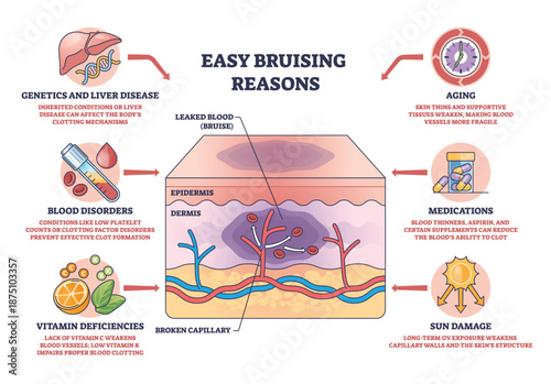 Easy bruising reasons diagram illustrates skin layers with broken capillary and leaked blood forming a bruise, key objects, skin cross-section, capillary, bruise. Outline diagram