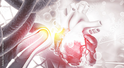 Fotografia Human heart angioplasty, stent implantation. 3d illustration
