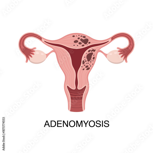 Medical illustration of adenomyosis in female reproductive system