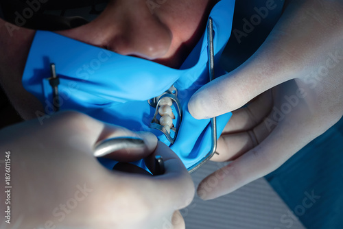 Foto Close-up of dentist placing a metal matrix and clamp to restore a cervical tooth defect