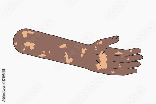 Black vitiligo hand, body part flat collage element vector