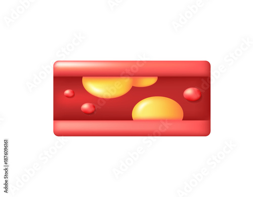 Cholesterol concept. 3d vector illustration of blood vessels with accumulated fat. Fatty plaques. Blood flow obstructed by cholesterol. Fat deposits. 3D style design. White background.