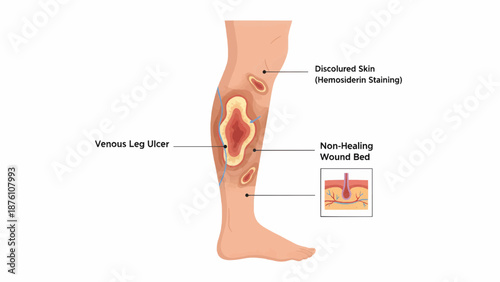Leg Ulcers Medical Condition Healthcare Illustration