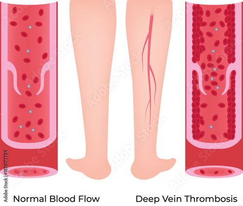 Deep Vein Thrombosis DVT Explained Normal Blood Flow vs Clot Formation