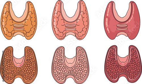 Thyroid gland anatomy, healthy and diseased states, medical cross-section illustration, endocrine system vector set, flat vector illustration