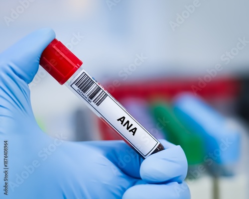 Canvas Print Blood sample tube for anti-nuclear antibody (ANA) test analysis.