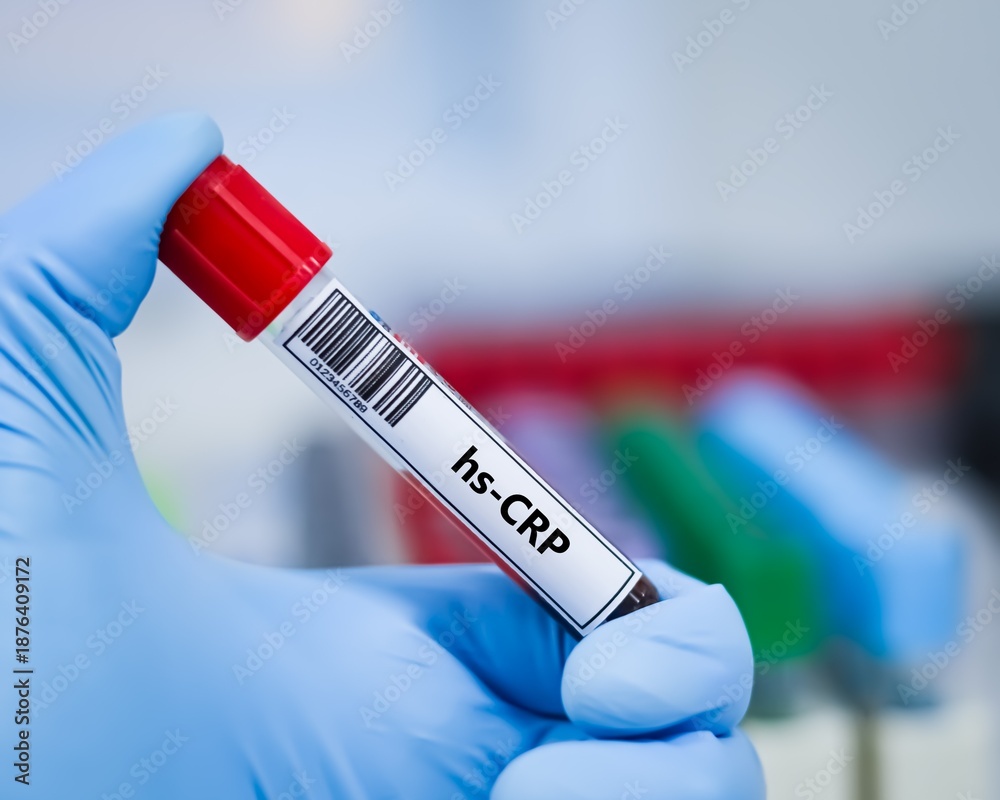 Fototapeta premium Blood sample tube for hs-CRP test analysis.