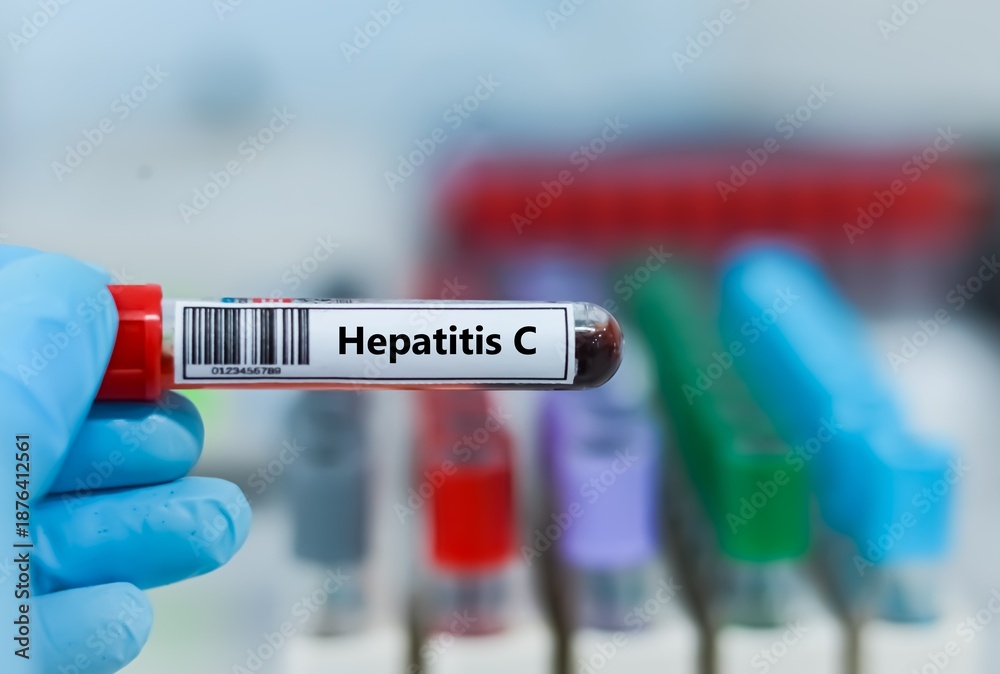 Fototapeta premium Blood sample tube for hepatitis C virus test analysis.