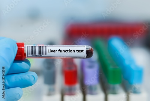Obraz na plátne Blood sample tube for liver function test  test analysis.